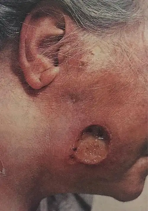 三期梅毒,结节破溃形成溃疡,境界清楚,边缘锐利,基底凹凸不平,有粘稠