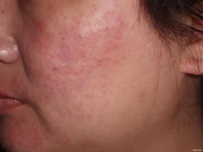 后逐步范围变大,现达面部,下颌部,额头少量,中间口服百癣夏塔热胶囊