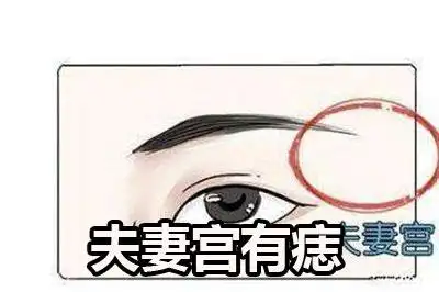 夫妻宫有痣需要去除吗