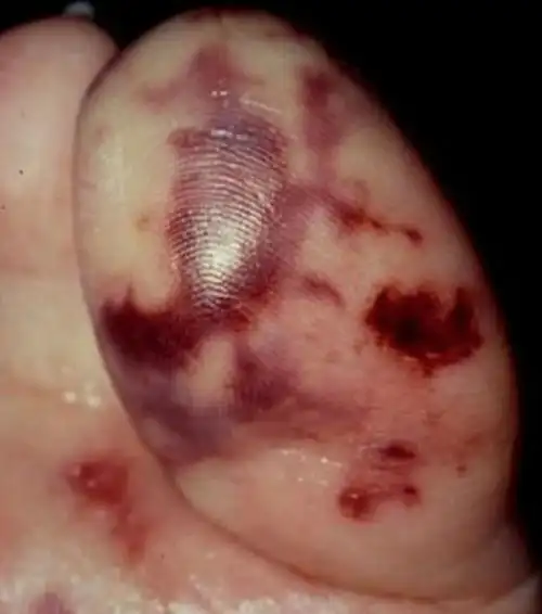 注意这13种皮肤变化,提示心脏疾病!