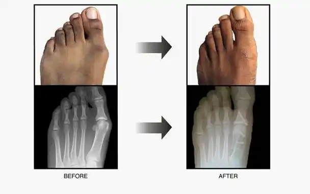 大脚拐,大脚趾内侧疼痛,要警惕:拇(趾)外翻,拇囊炎