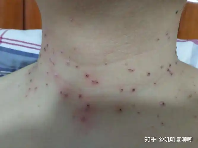 丝状疣脖子上女性医生说要激光扫有别的办法吗