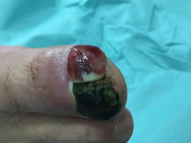 看图识病化脓性肉芽肿