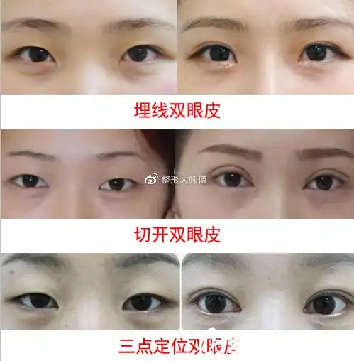 埋线双眼皮,切开,三点定位案例效果对比图