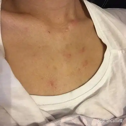 我胸口的皮肤这是怎么了鸡皮肤好多痘痘红点点我该怎么改善这里的皮肤