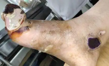 严重感染的糖尿病足险遭截肢最后一个足趾都不少这样处理最有效