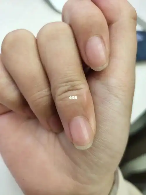 姐妹们你们的右手中指也是这样吗