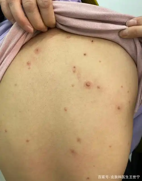 传染性软疣和毛囊炎能分的清吗