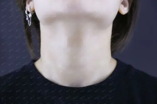 术前求美者脖子颈纹明显且深,颈部曲线不美观,颈部皮_圈子-新氧美容