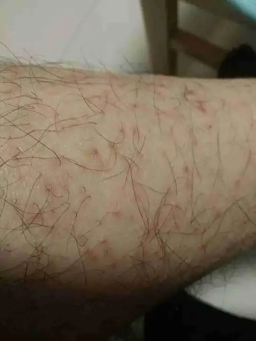 小腿毛囊发红,痒,少部能挤出来白色粘稠液体(有点像脓).