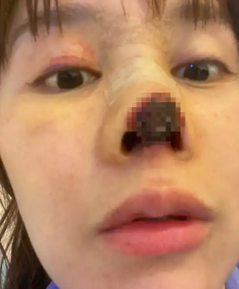 31岁女星整容失败遭毁容,鼻头坏死触目惊心,维权无果欲跳楼