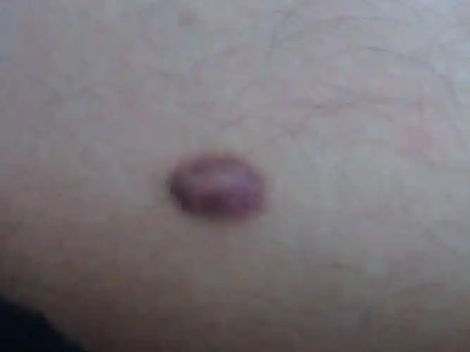 大腿上长了一颗东西,谁能告诉我这是什么东西,带图片