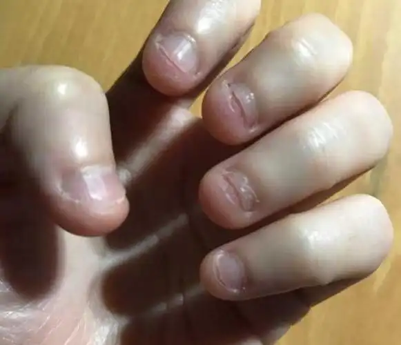 爱咬指甲的孩子,都逃不过这5种结局!