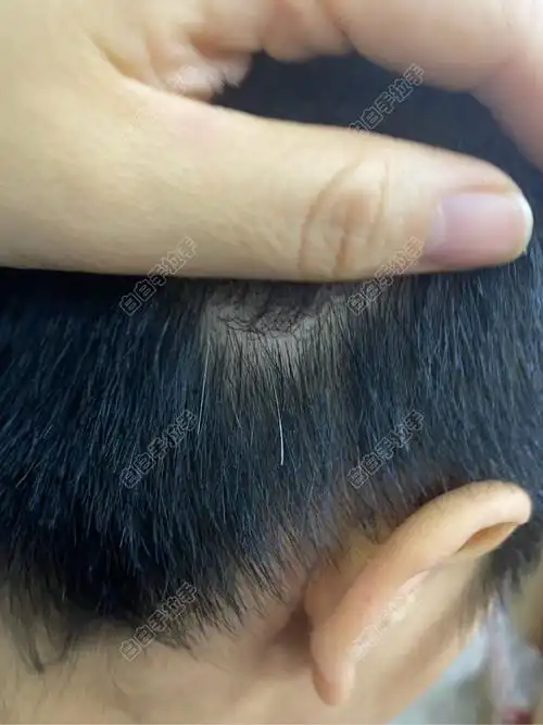 最近发现长了几根白发不知道是不是白白