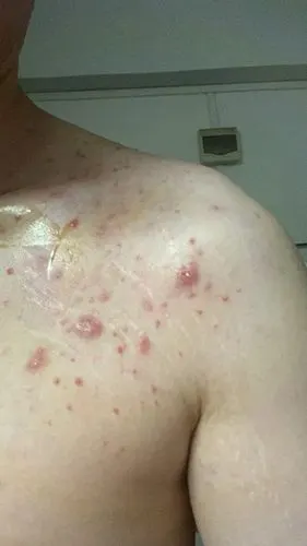 脓疱结节性毛囊炎