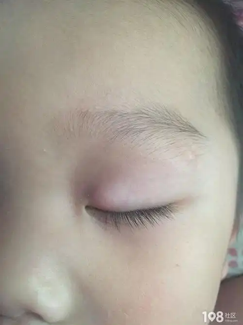 儿子眼皮长了个大包包,不疼不痒会是麦粒肿吗?
