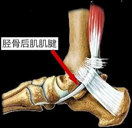 「运动康复」胫骨后肌失能与扁平足-跑者的噩梦