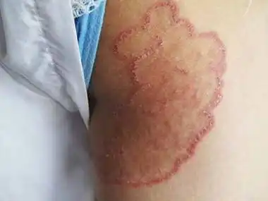 股癣是什么原因所引起的