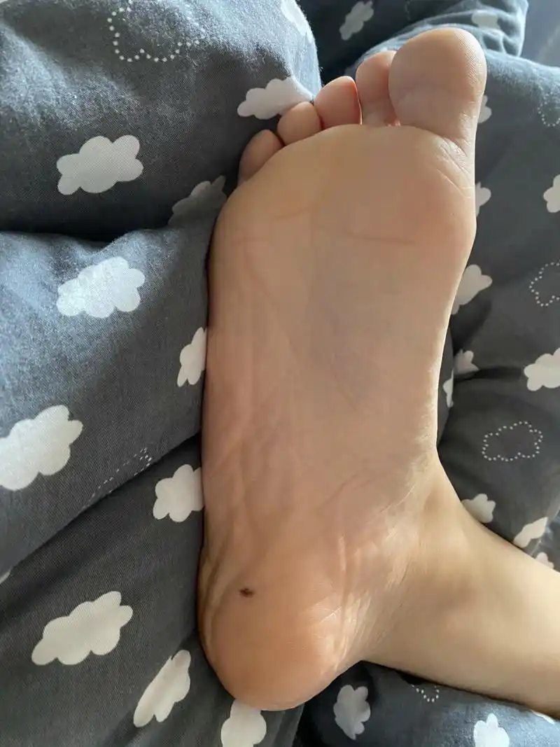 不懂就问 脚底黑痣 一大早刷到脚底痣,整个人都很恐慌,不痛不痒,不