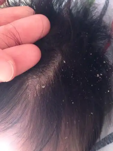 推荐回答 头屑   这是头部角质层异常增生脱离   用专门的头癣头屑