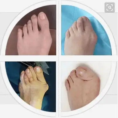 北京丰台广济医院科普:脚上有凸出来的骨头怎么办?_手术_并发症_治疗