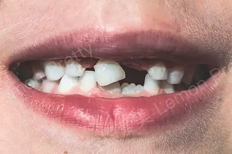 牙齿缺失怎么办?如何选择适合自己的牙齿修复方法?_柠檬爱美_种植牙