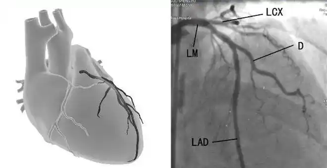 科普肾炎患者适不适合做冠脉造影