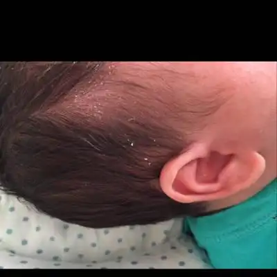 宝宝现在40天了 头皮都起皮了是怎麼回事 这是什麼呀?