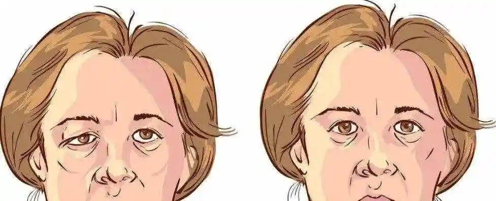 下眼睑皮肤松弛眼皮下垂的原因有哪些