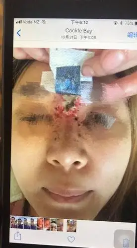 微整形变毁容中国女留学生美容院隆鼻导致山根腐烂