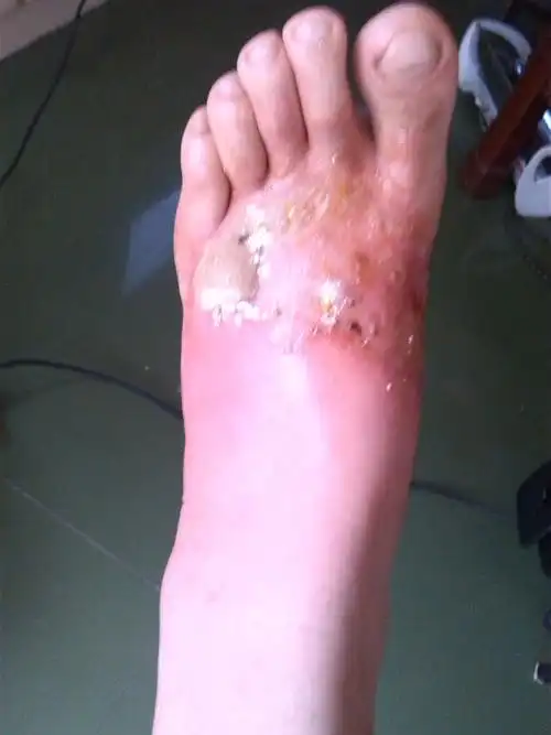 昨天开水烫伤左脚面,起了大水泡.水泡破了的脚面有点肿