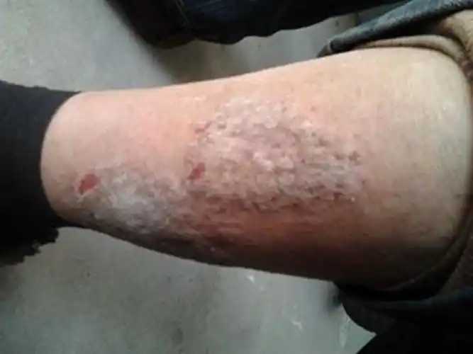 孕妇疥疮初期腹部皮肤症状图片