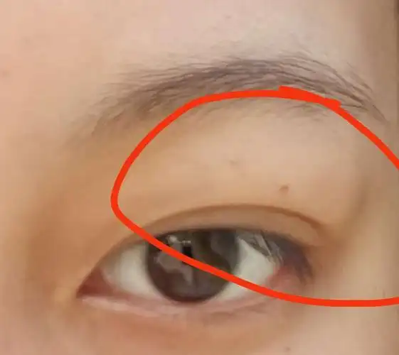 但很肿,就是平时去刮一下都可以听到咯吱咯吱的响声,摸得到水肿的感觉