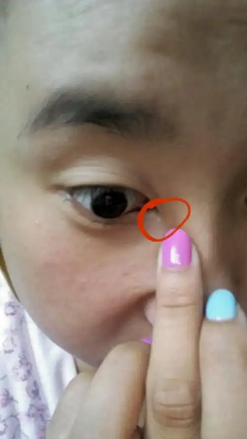 眼角长个疙瘩,不痛不痒的,咋回事.