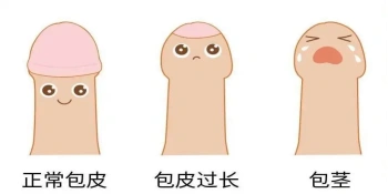 3岁以下男孩子多表现为生理性包茎,如果没有合并局部反复炎症或排尿不