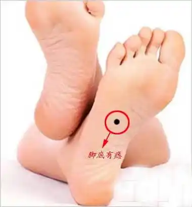 右内踝有痣女人代表什么「右内踝有痣女人代表什么图解」