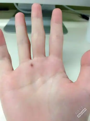 有没有人跟我一样手心有颗痣啊