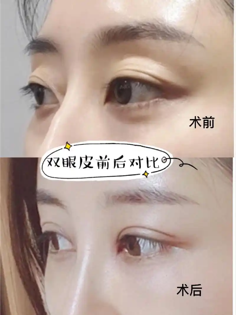 原来眼窝凹陷除了玻尿酸填充,还可以这么做!