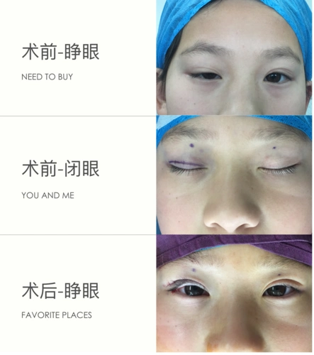 上睑下垂上睑肌无力手术照片2017年