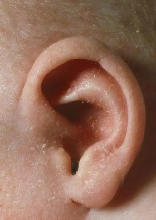 耳科专家提醒耳朵里面经常痒可能预示着这3种病最好上点心