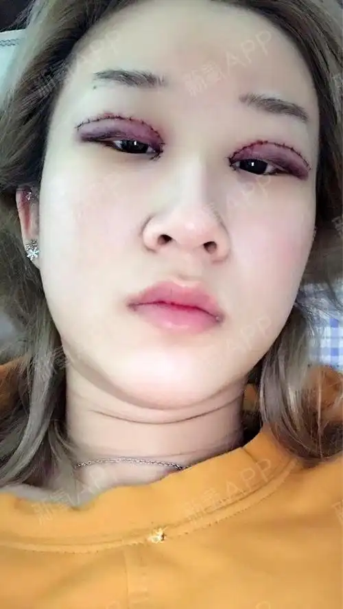 我的眼睛内眼角包的严严实实的