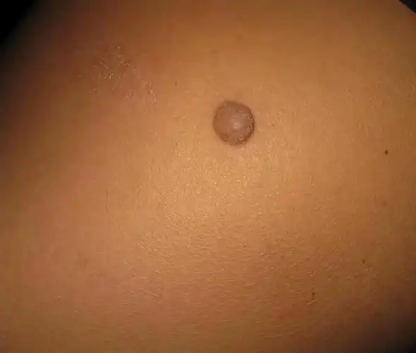 皮肤长小肉球是怎么回事可以抠掉吗如何处理一文看懂