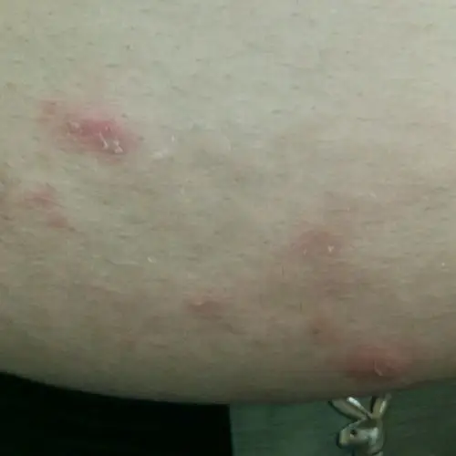 广州市南沙区新沙医院 擅长领域 荨麻疹,痤疮,湿疹,扁平疣,股癣,疥疮