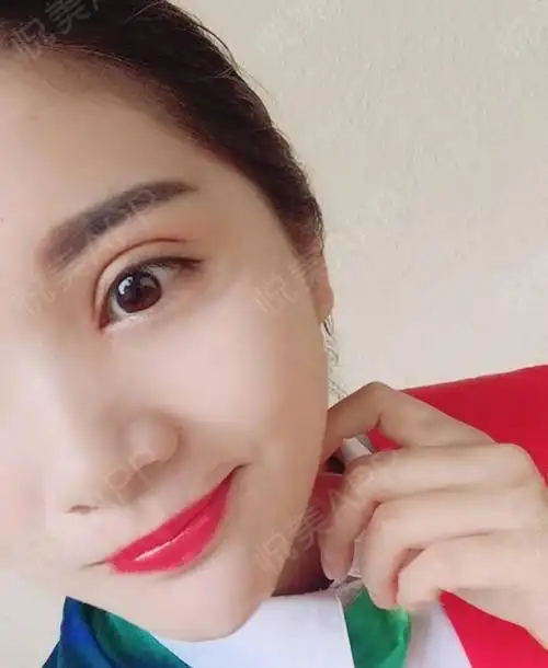 眼综合整形术后16天_全切双眼皮术后16天_眼型矫正术后16天_眼综合术