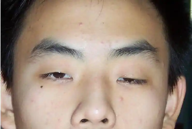 眼角膜都有移植的为什么重度眼睑肌无力没有移植手术呢