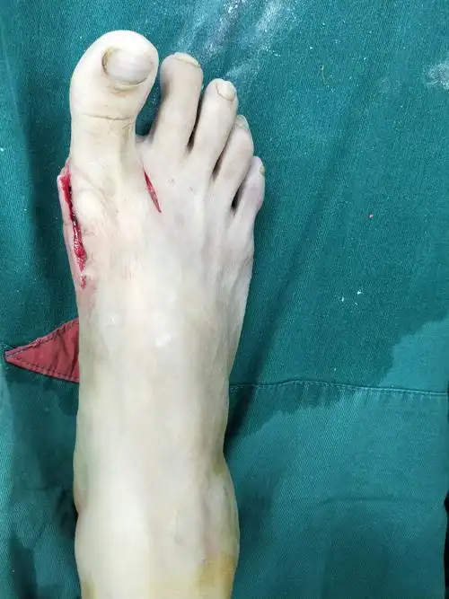 在临床选择中有很多种方法,根据跖骨截骨部位大致分为远端截骨,中段截