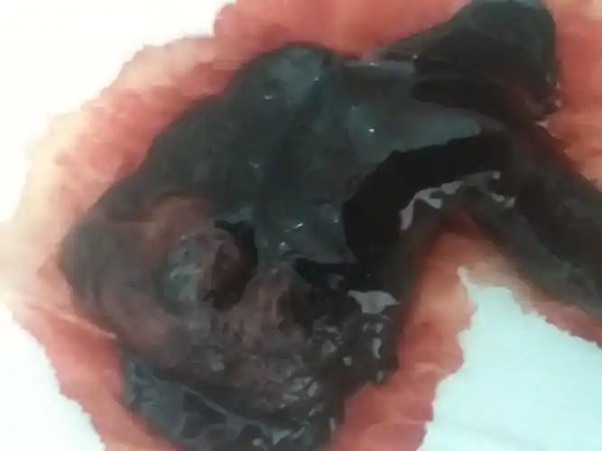 本人怀孕三个月左右自然流产,流产时间是八月三号,流了五天少量的血就