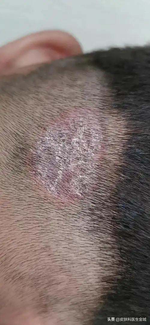 自制香柏波治疗头皮脂溢性皮炎妙招.头皮脂.