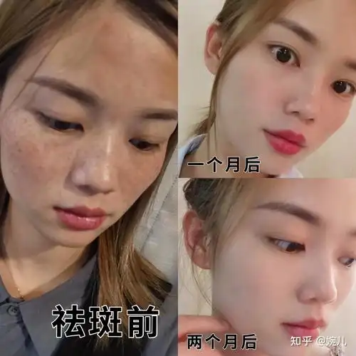祛斑前后对比还是比较满意的