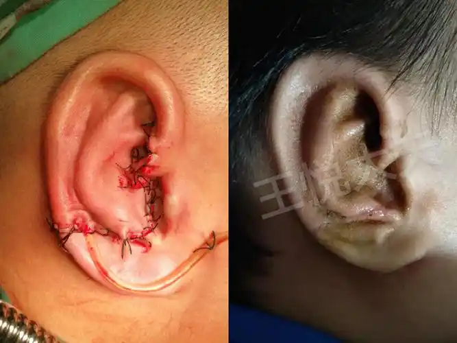 小耳再造手术典型病例照片(持续更新中)_耳再造_耳再造治疗介绍 - 好